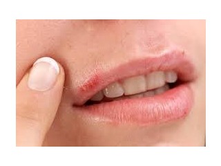 Mananging Herpes Symptoms:Acivir Cream