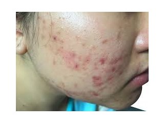 Benzaclin Your result for Acne- Purchase Securely for Clearer Skin - New York City