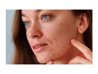 Minocycline 100 mg capsule for acne - New York City